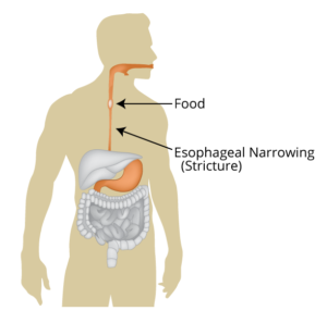 Tablet what if stuck do in throat to antibiotic tablet