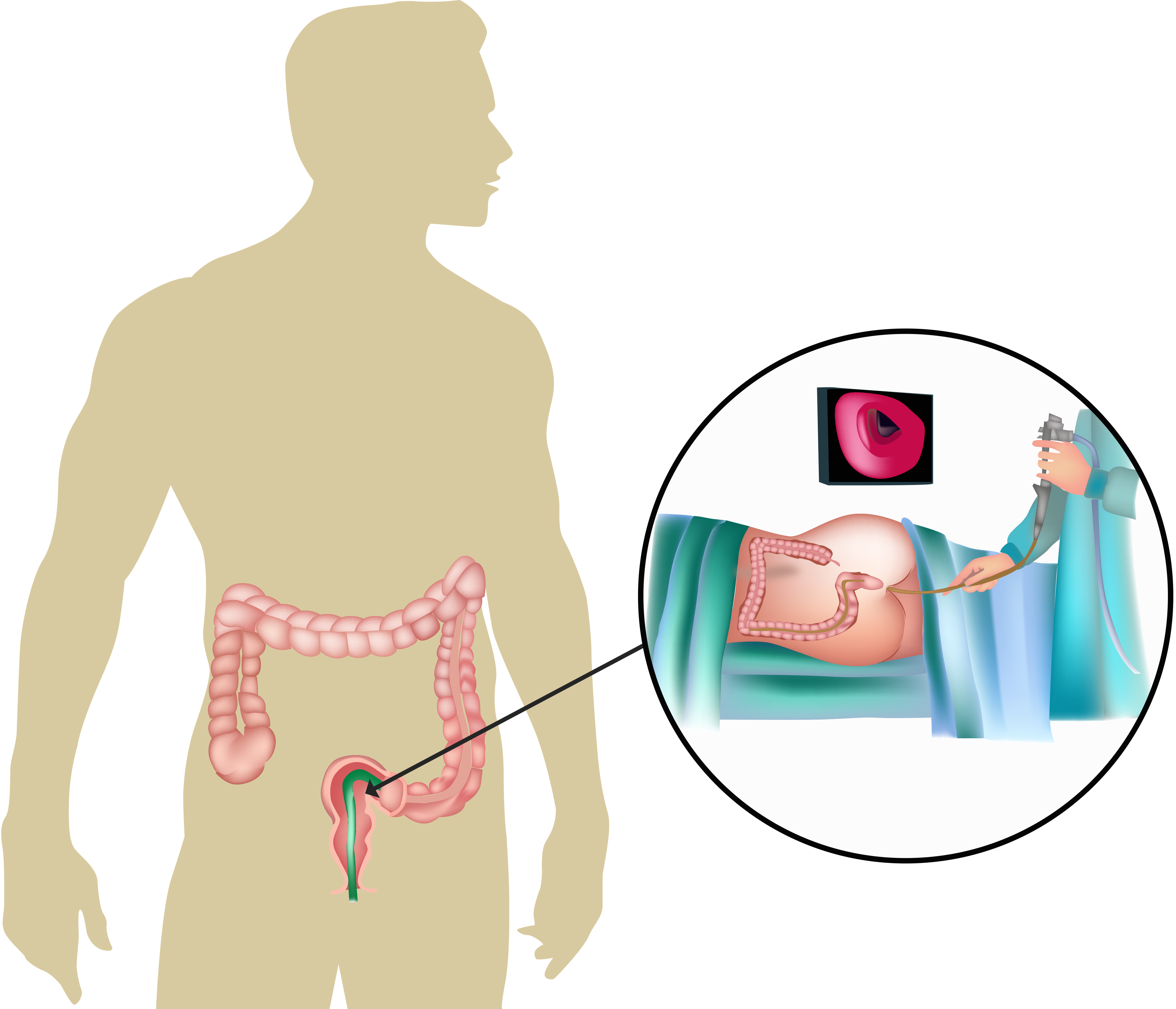 Flexiblesigmoidoscopy sigmoidoscopy