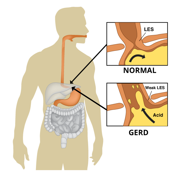 What causes acid reflux in throat