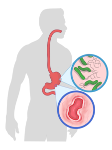 Helicobacter_pylori