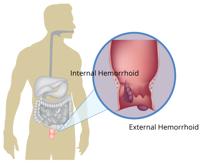 Hemorrhoids