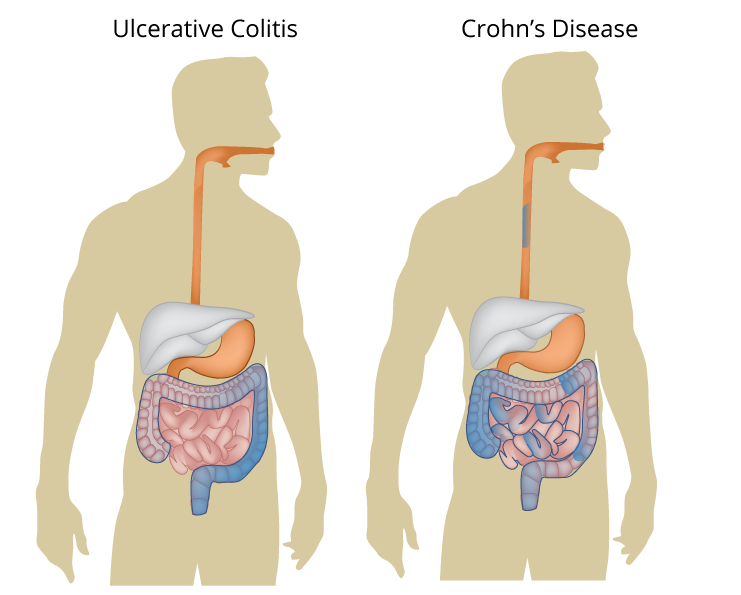 Inflammatory Bowel Disease, Colitis & Crohn's Disease