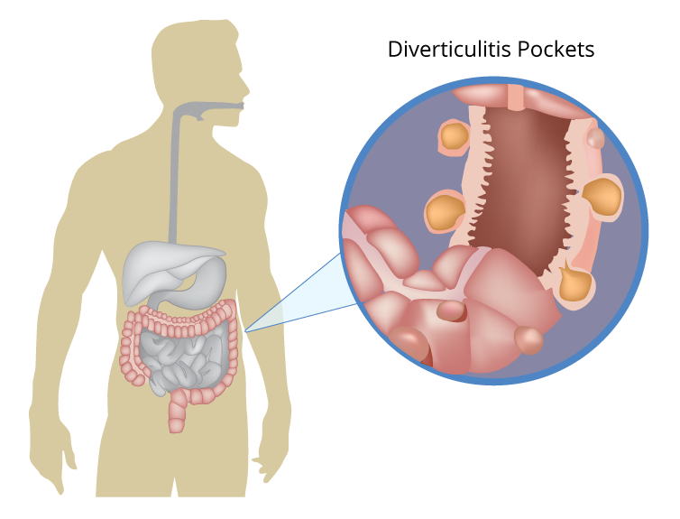 diverticulitis2